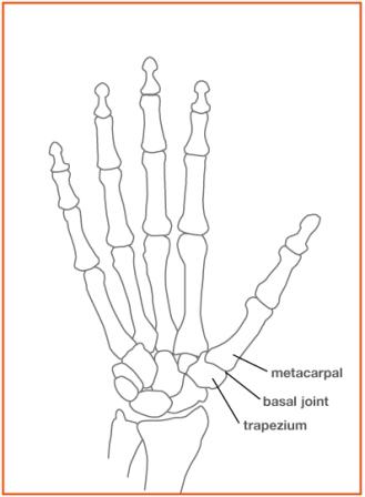 How successful is surgery to replace the joint at the base of the thumb?