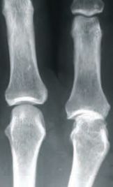 MetaJointArthritis Image 3