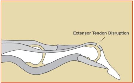 Extensor2 Sprains Image 2