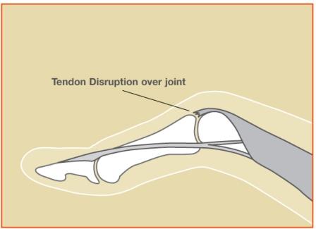 Extensor3 Image 3