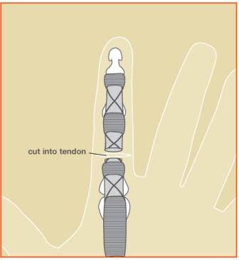 Flexor Tendon Image 2