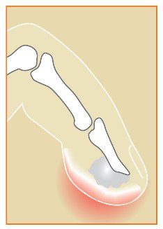Infection_image2