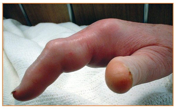 Infection_image2