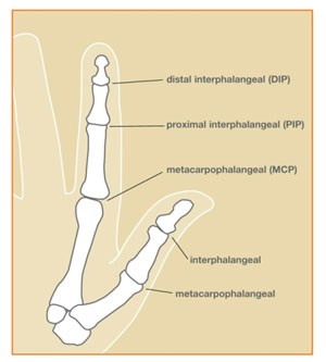 MetaJointArthritis Image 1