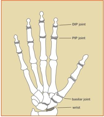 osteoarthritis Image 1