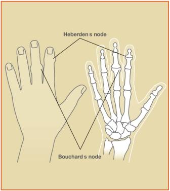 osteoarthritis Image 2