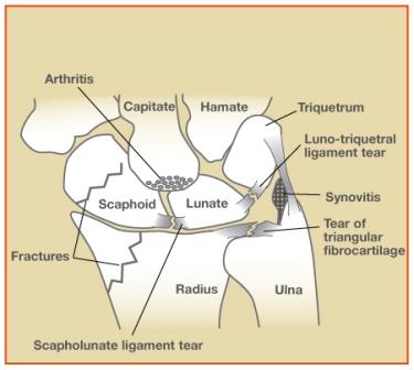 Wrist Sprains Image 1