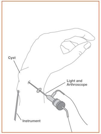 Wrist Sprains Image 3